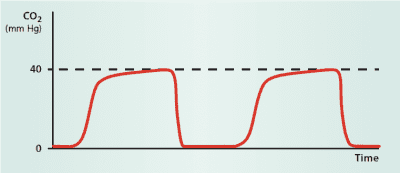 Top 10 Essentials: Care of Patients on Ventilators.- American Nurse