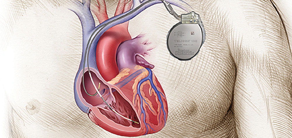 Implantable cardioverterdefibrillator Not just another