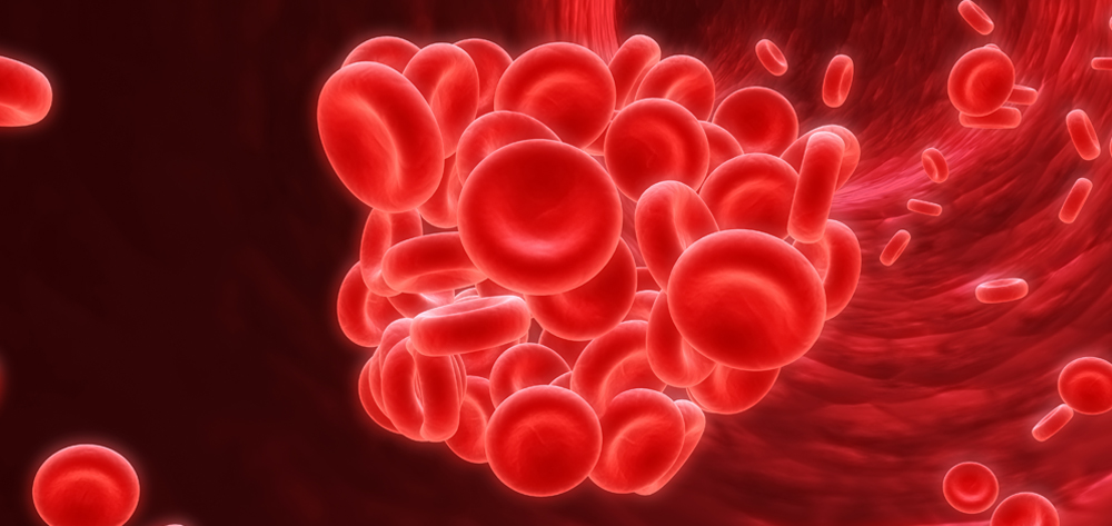 Detecting, managing, and preventing pulmonary embolism