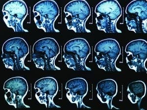 Is your patient at risk for cerebral edema?
