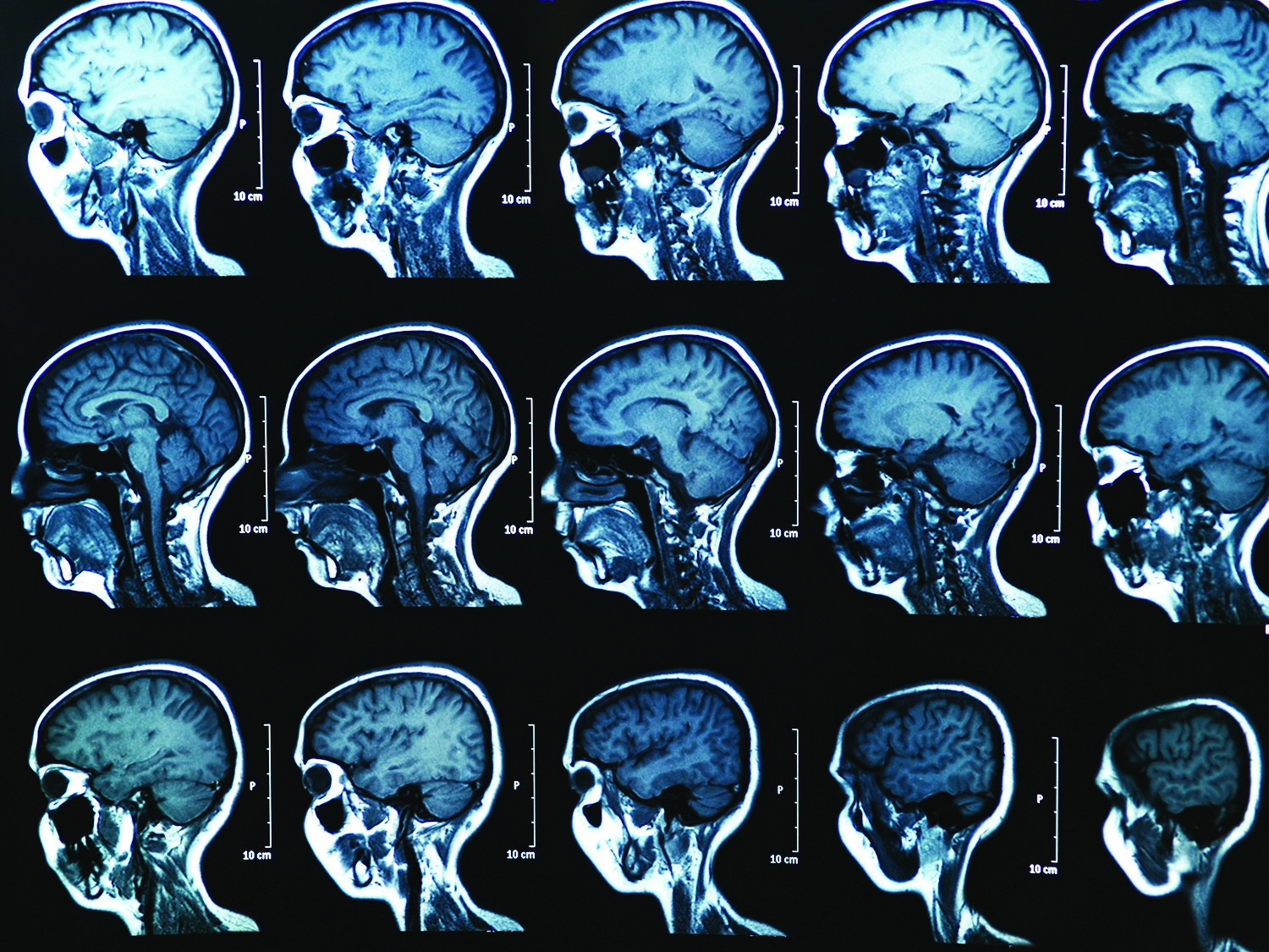 Is your patient at risk for cerebral edema?