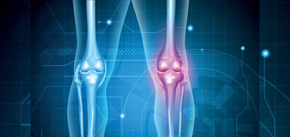 Osteoarthritis