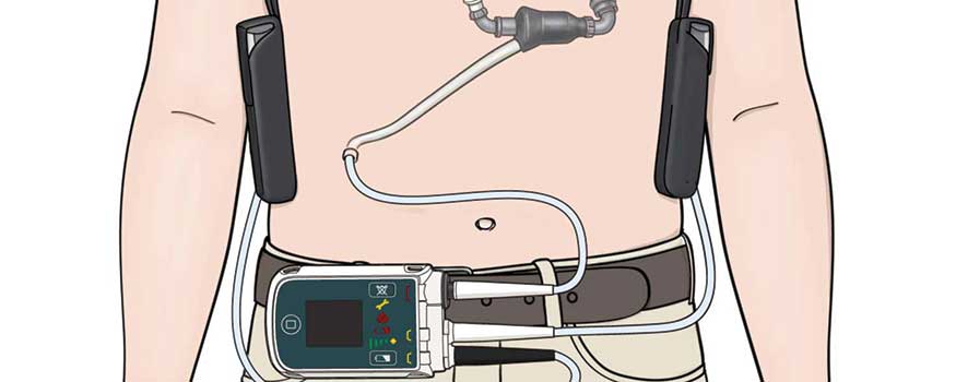 left ventricular assist device