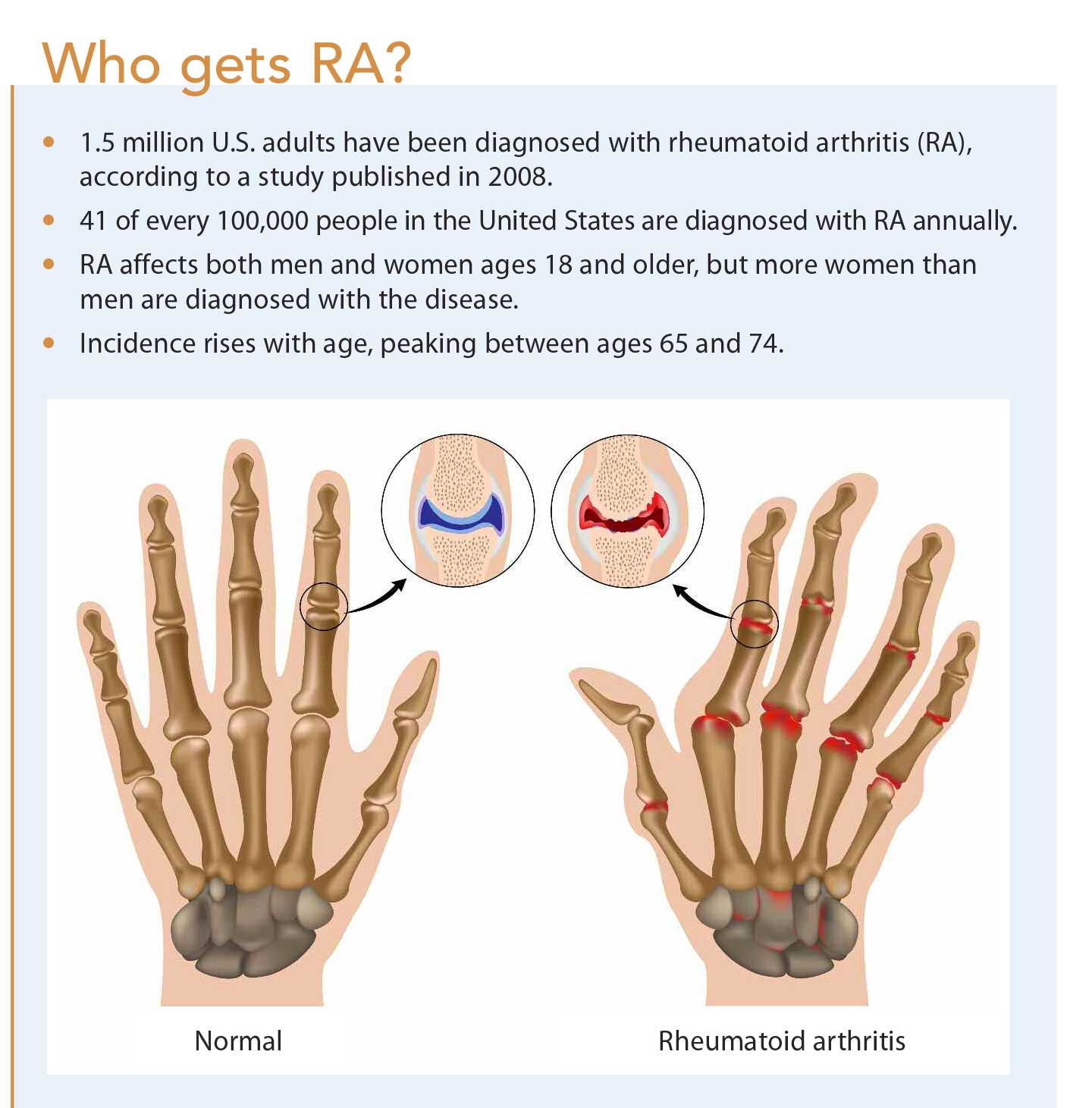 Reumatoid artritisz – Wikipédia