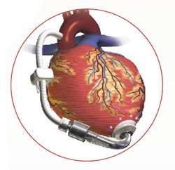 caring for patients with a left ventricular assist device