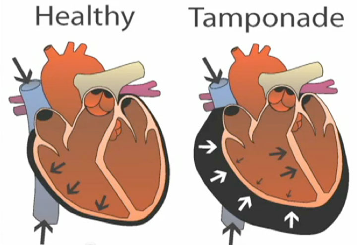 Acute cardiac tamponade