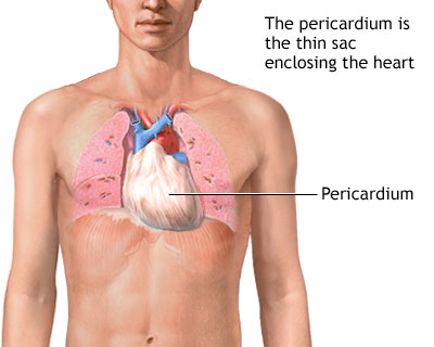 Acute cardiac tamponade