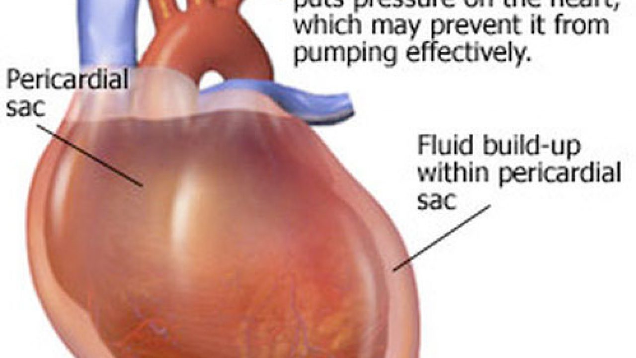 Acute Cardiac Tamponade American Nurse