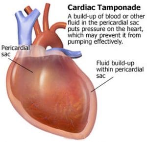 Acute cardiac tamponade