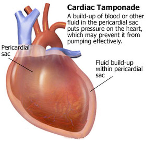 cardiac tamponade symptoms