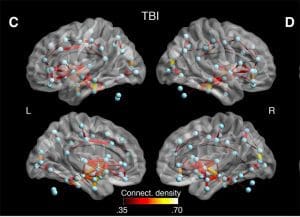 Detecting long-term concussion in athletes