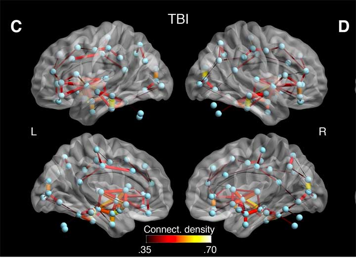 Detecting long-term concussion in athletes