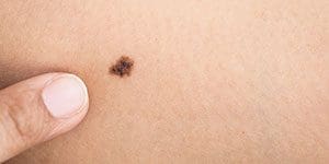 melanoma risk factors kidney transplant