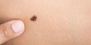 melanoma risk factors kidney transplants