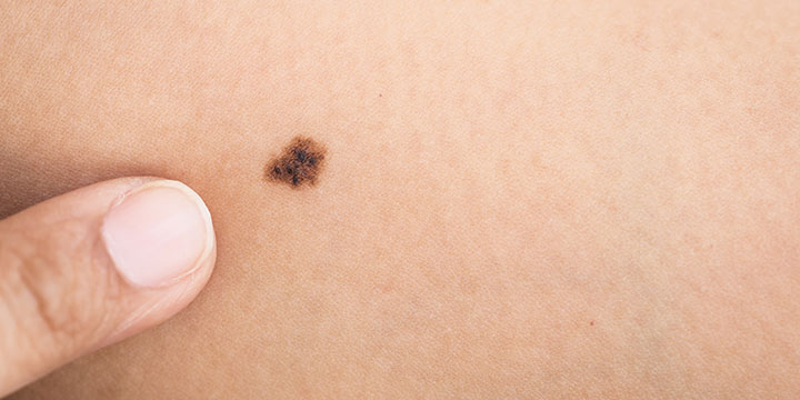 melanoma risk factors kidney transplants