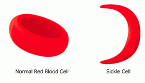 sickle cell disease