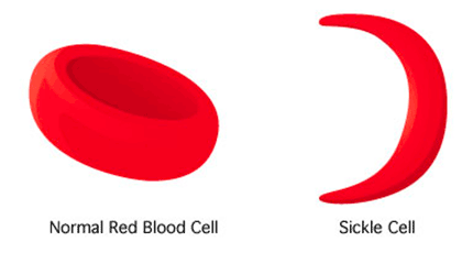 sickle cell disease