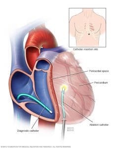 ablation atrial fibrillation drugs wca