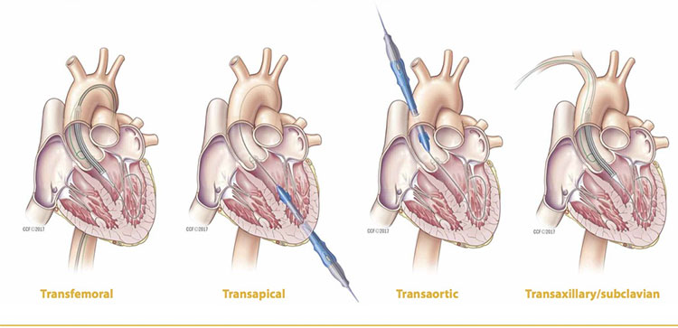 Caring for Patients after Transcatheter Aortic Valve Replacement