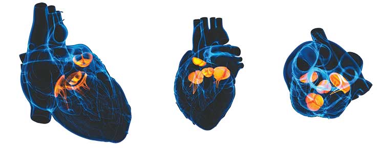 patient care after transcatheter aortic valve replacement