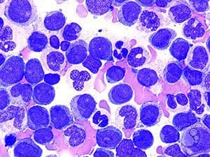 fda mylotrag treatment acute myeloid leukemia
