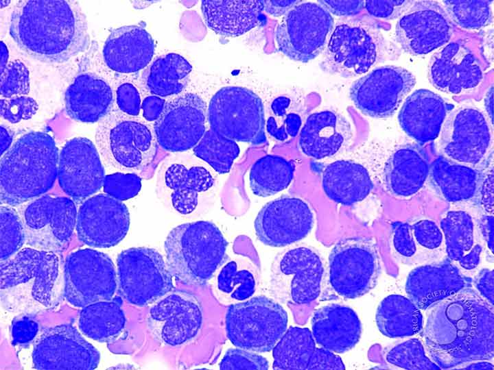 mylotrag treatment acute myeloid leukemia