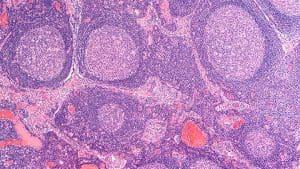 follicular lymphoma fda treatment