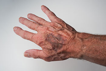 detect elder abuse neglect