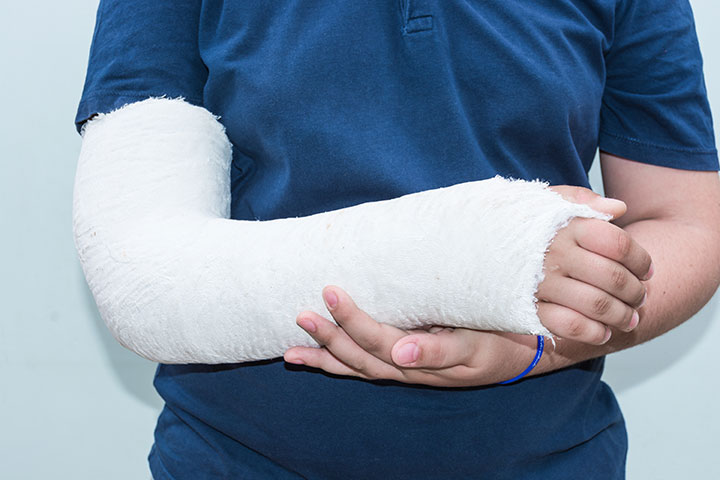 Broken arm Broken arm