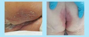 incontinence associated dermatitis management update