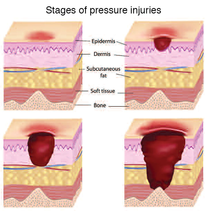 Critical care of the skin - American Nurse Today