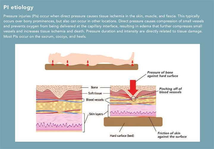 solve causes pressure injuries etiology