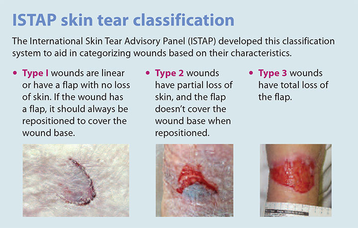 tear assessment management prevention istap classification