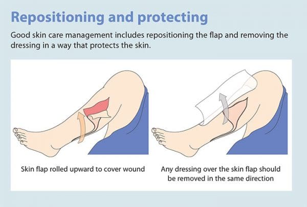 Which Of The Following Actions Helps To Prevent Skin Tears