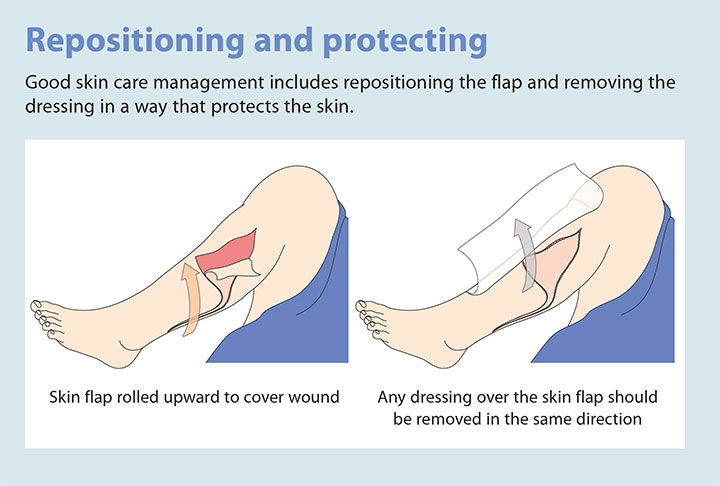 tear assessment management prevention repositioning protection