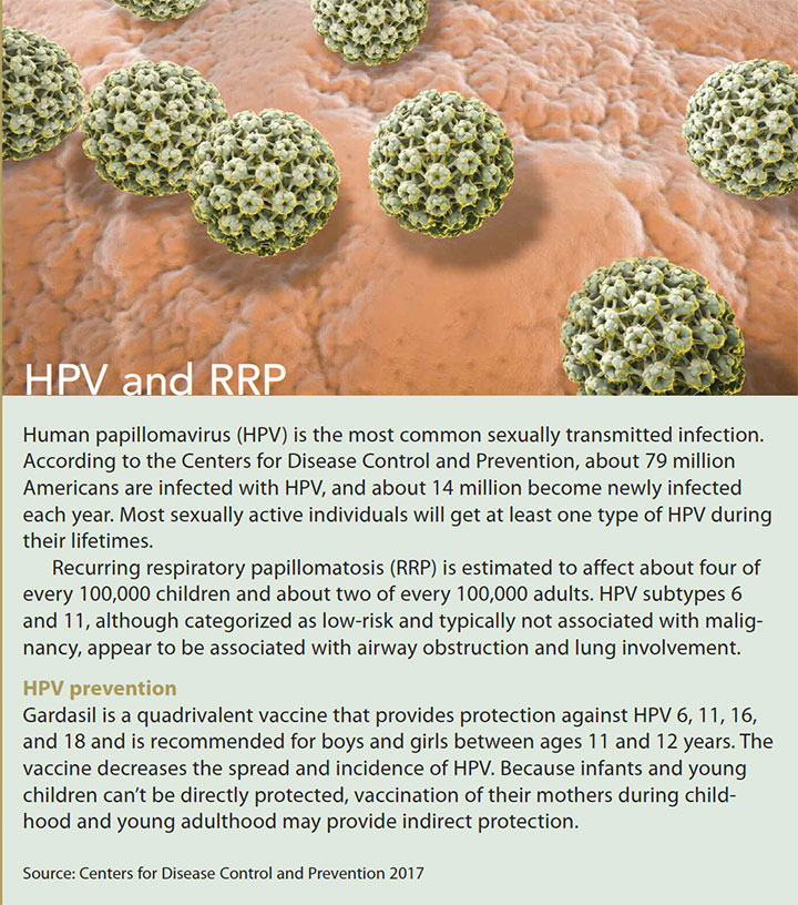 recurrent respiratory papillomatosis hpv rrp