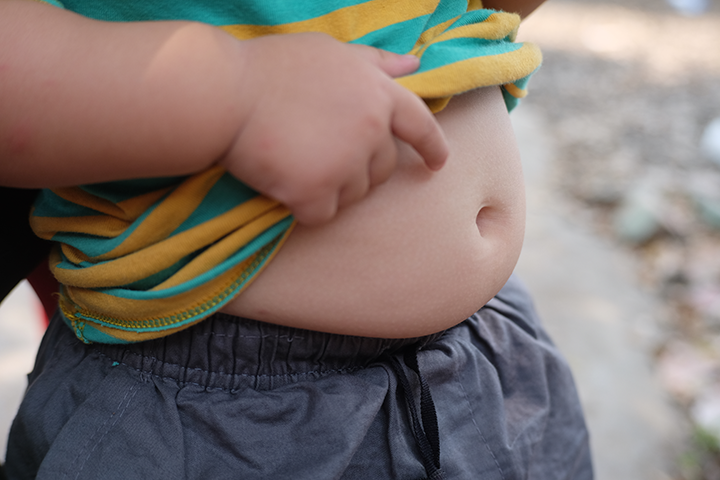 obesity children developmental delays