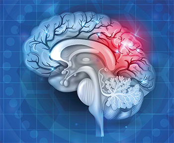 reducing readmissions in stroke patients post