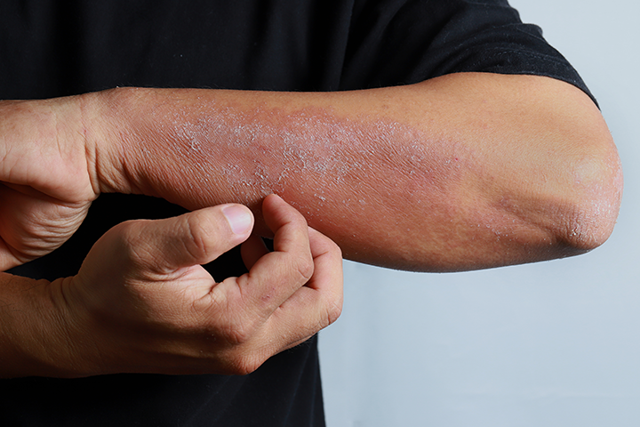 manage severe atopic dermatitis manage severe atopic dermatitis