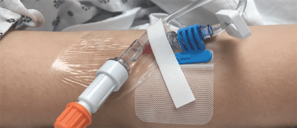 Rotating Peripheral IV Catheters Based On Clinical Indication American Nurse