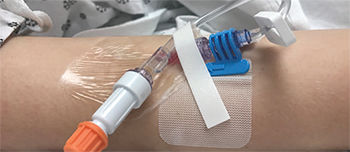 rotating peripheral iv catheters post