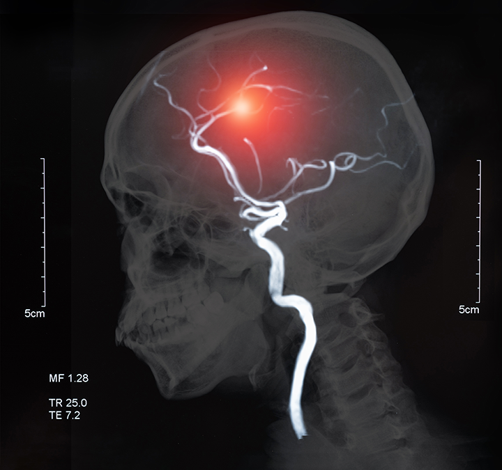 cilostazol aspirin clopidogrel reduces recurrent stroke