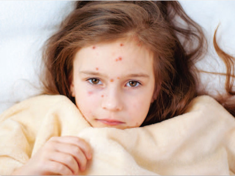 Child with measles