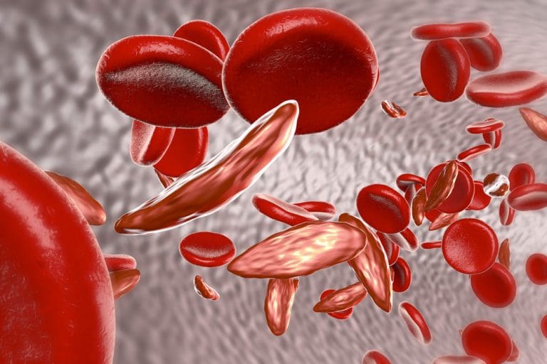 Accelerated approval for new sickle cell disease treatment Accelerated approval for new sickle cell disease treatment