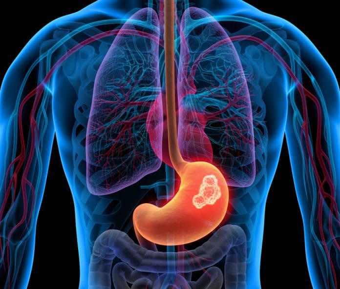 First targeted therapy for rare mutation of gastrointestinal stromal