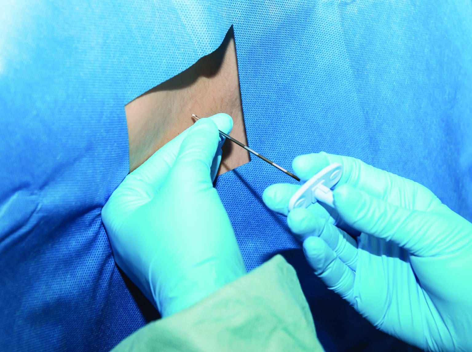 An overview of neuraxial anesthesia American Nurse