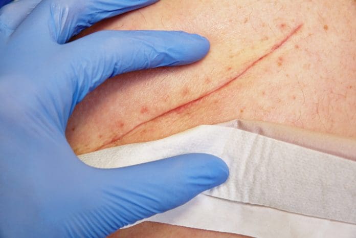 wound care scar