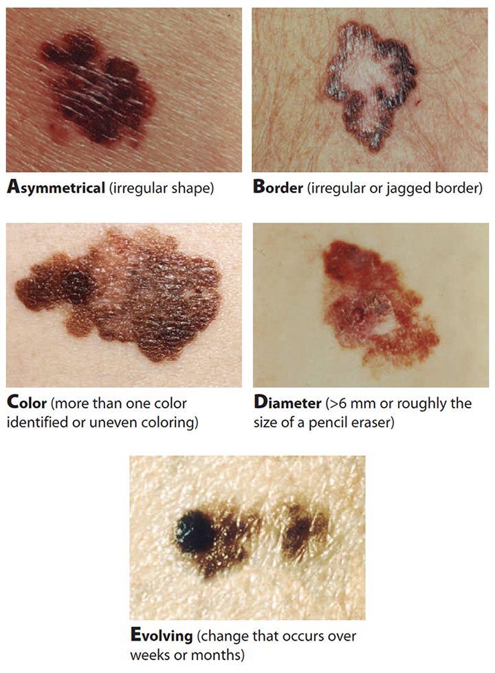 Melanoma mitigation - the key to higher survival rates