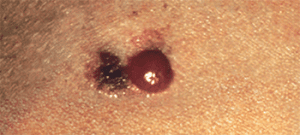 mitigating-melanoma-amelanotic