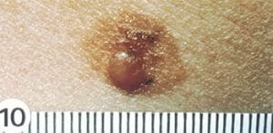 mitigating-melanoma-dysplastic-nevus